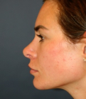 Feel Beautiful - Revision Rhinoplasty 201 - After Photo